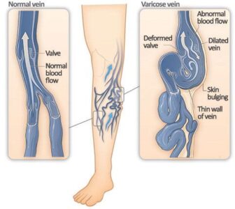 Send Varicose Veins Packing with this Surprising Change Image